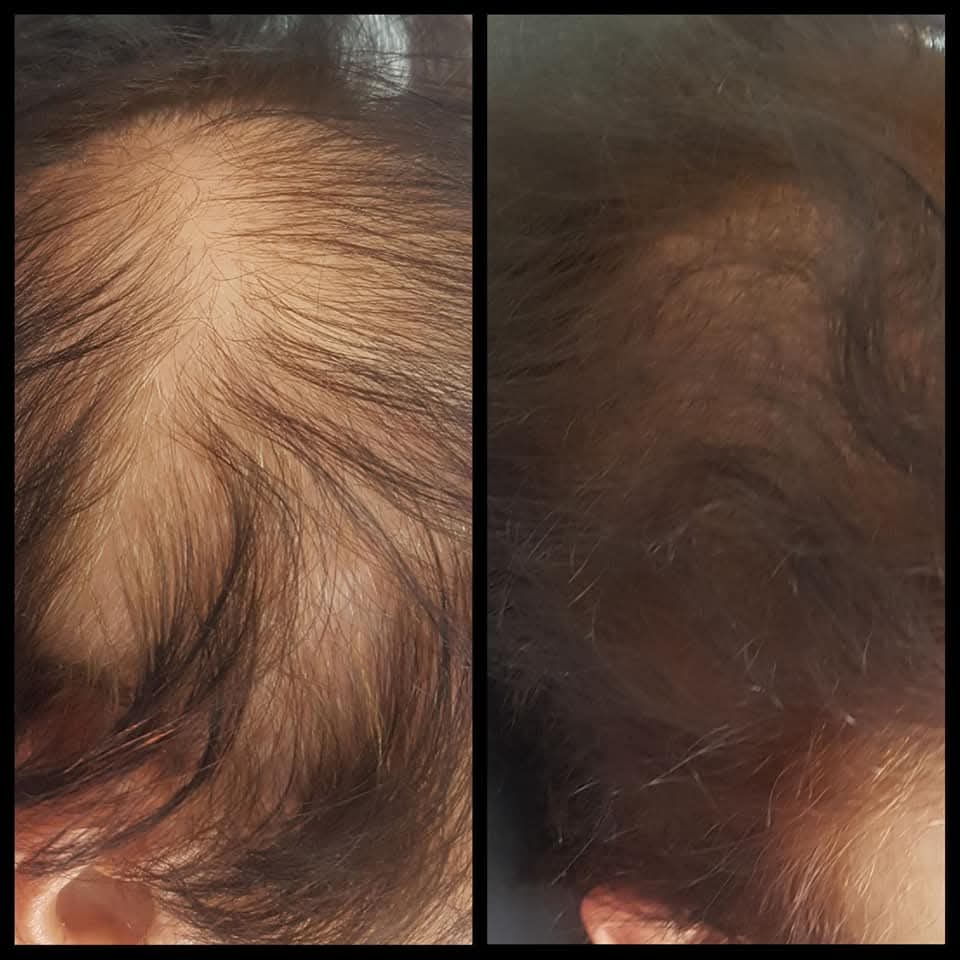 Tricopigmentação Capilar