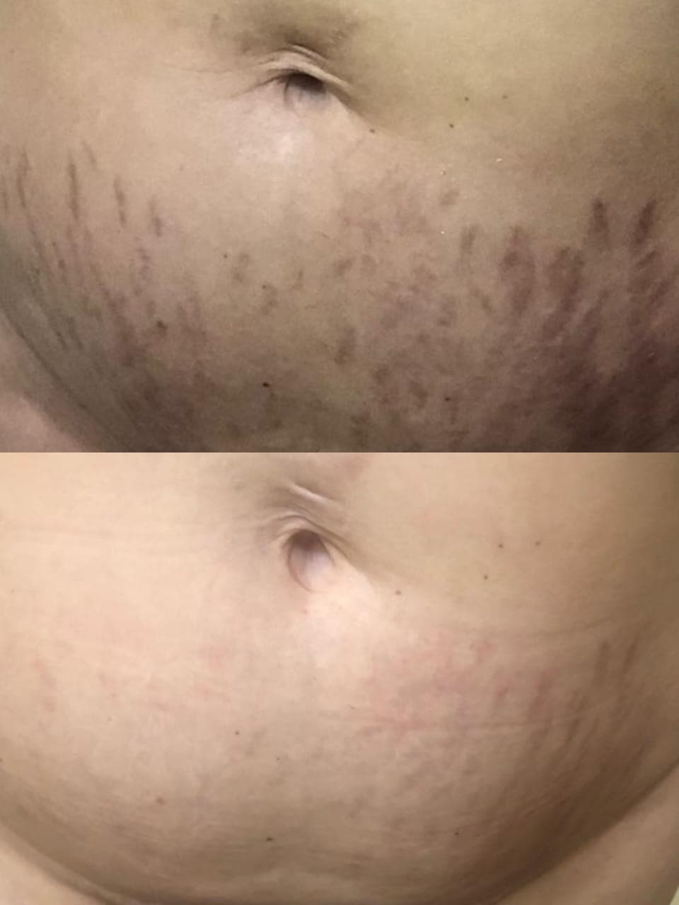 Reconstrução de Estrias