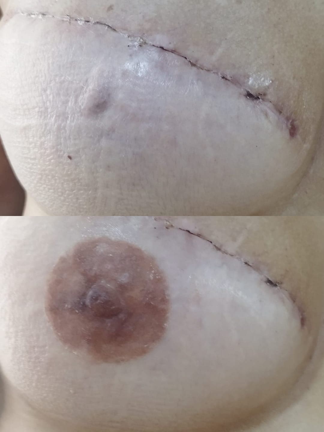 Prótese de aréola mamária